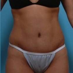 Manhattan abdominoplasty after 1